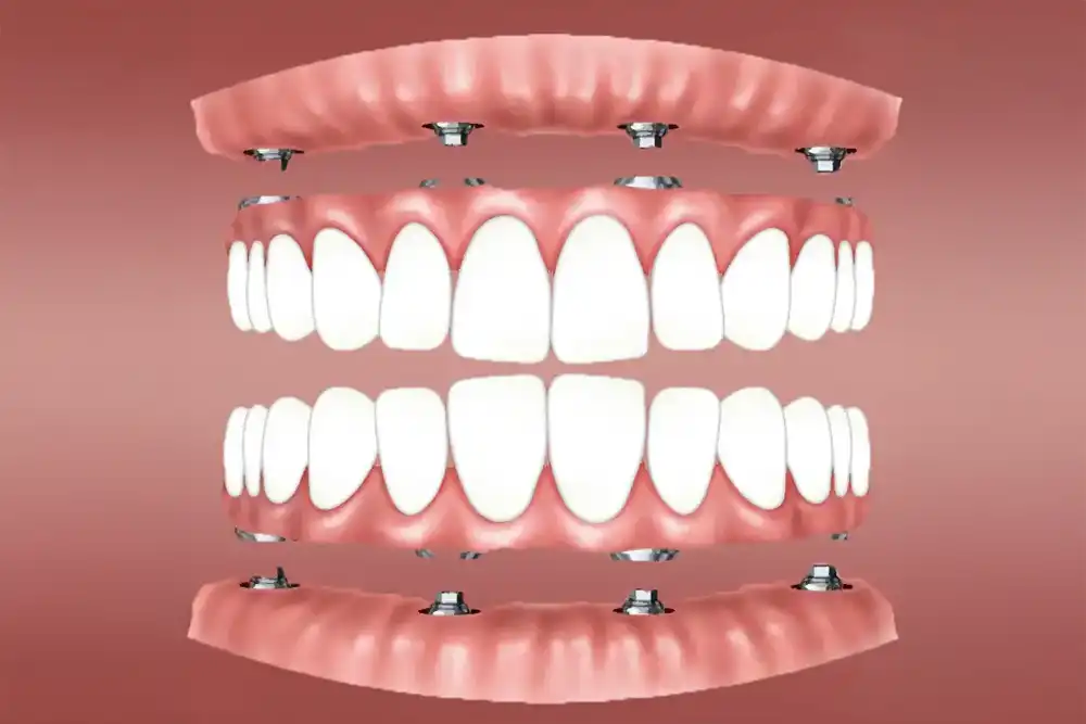 Costi per impianti dentali guida chiara