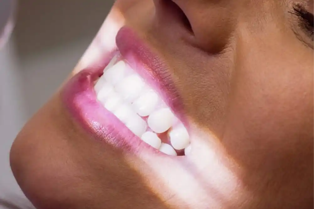 Sbiancamento dei Denti