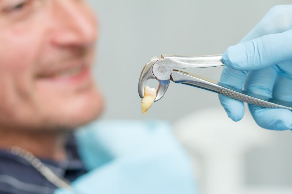 Estrazione dentale prezzi
