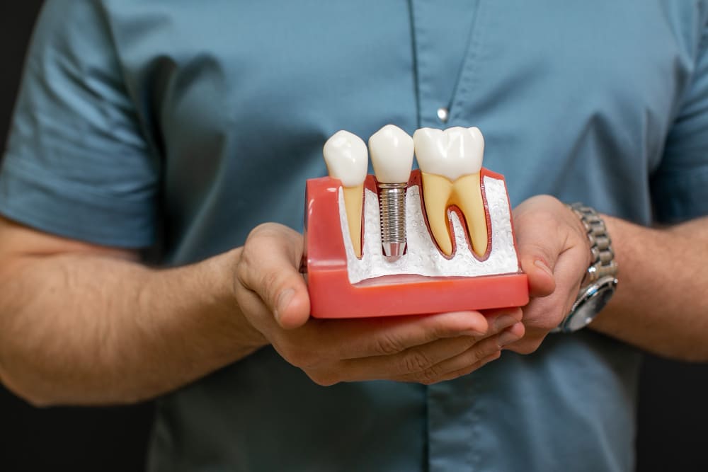 durata degli impianti dentali