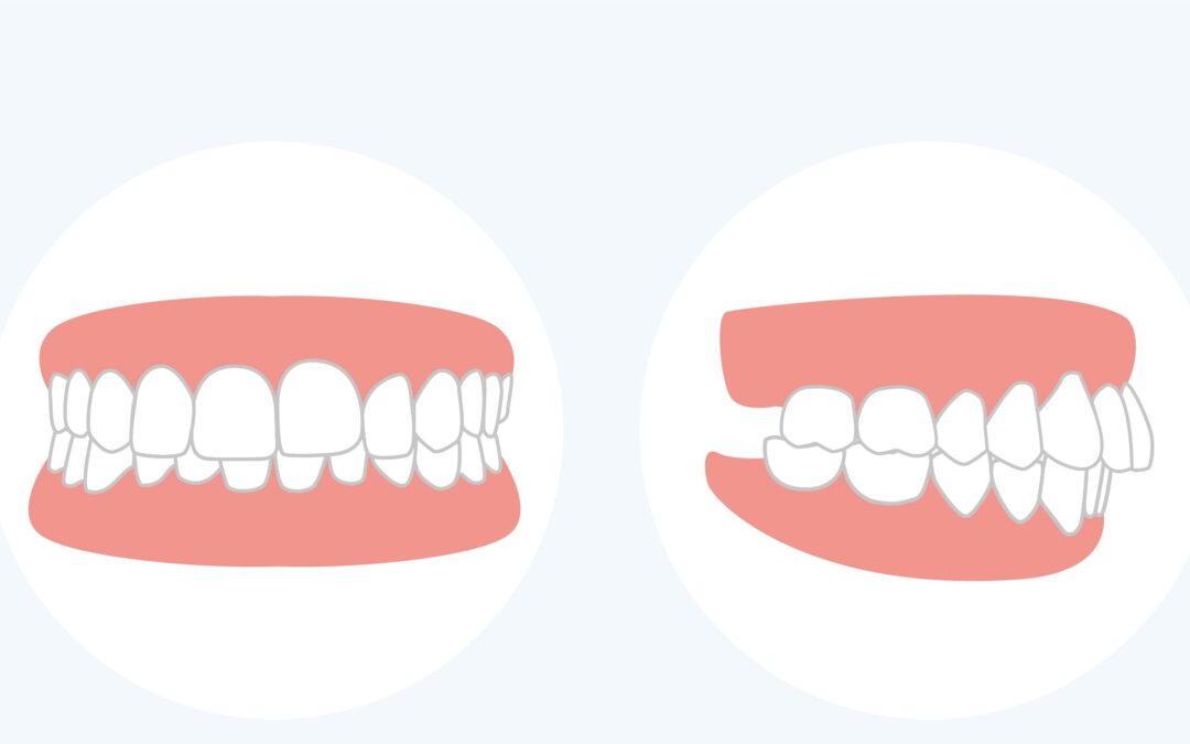 Malocclusioni dentali: cause, sintomi e trattamenti correttivi