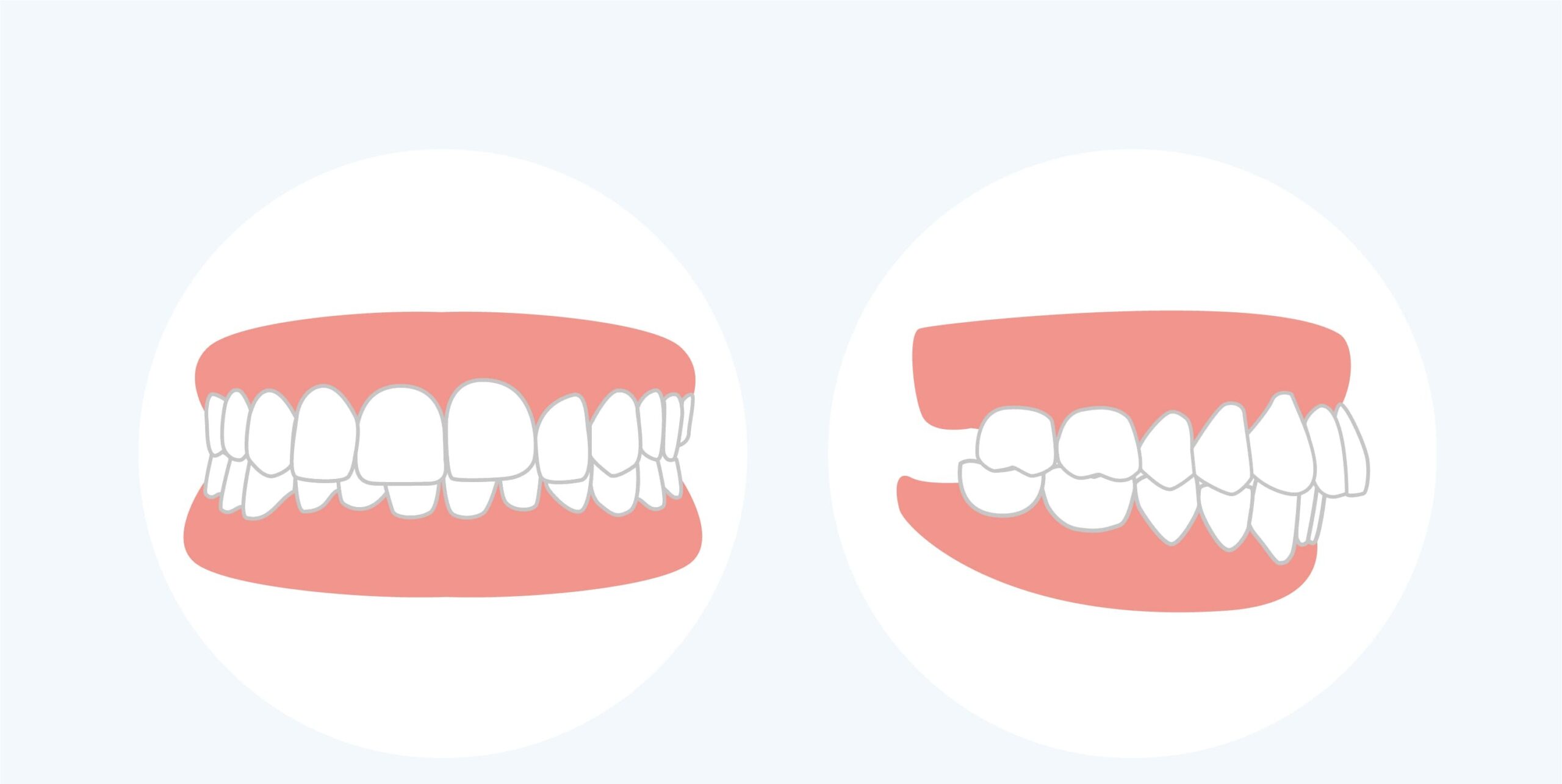 malocclusione dentale