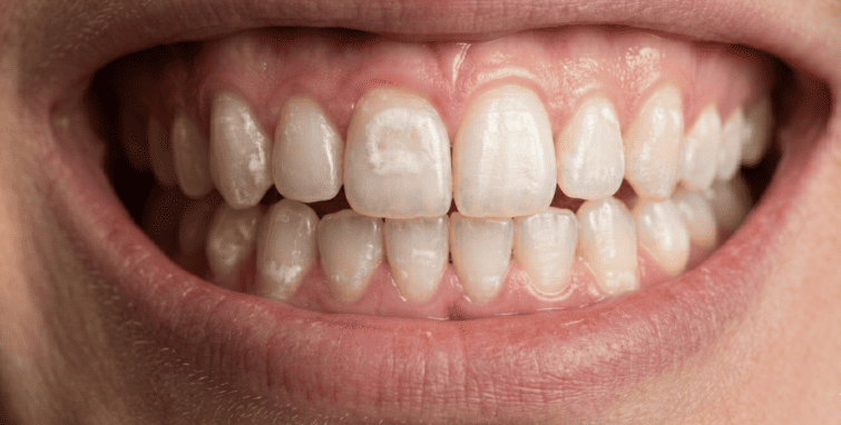 Demineralizzazione dello smalto