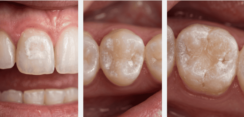 Demineralizzazione denti