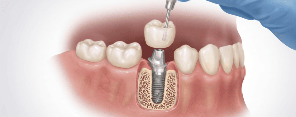 Implantologia non invasiva: cos’è la tecnica Flapless